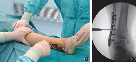 syndesmosis tear test|repair of syndesmosis.